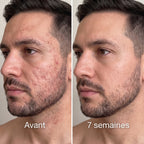 Soreva™ Stick pour le remodelage des cicatrices
